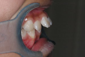つくば・土浦の矯正歯科　つるみ矯正歯科　歯並び矯正症例C　上顎前突（出っ歯）
